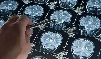 Alzheimer araştırmalarında yeni keşif: Riski artıran genetik varyant bulundu