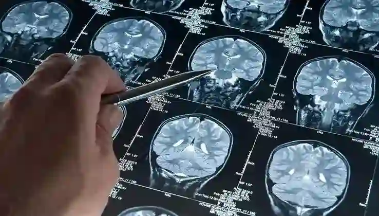 Alzheimer araştırmalarında yeni keşif: Riski artıran genetik varyant bulundu