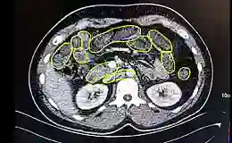 Midesinde uyuşturucu saklayan üç kişi yakalandı
