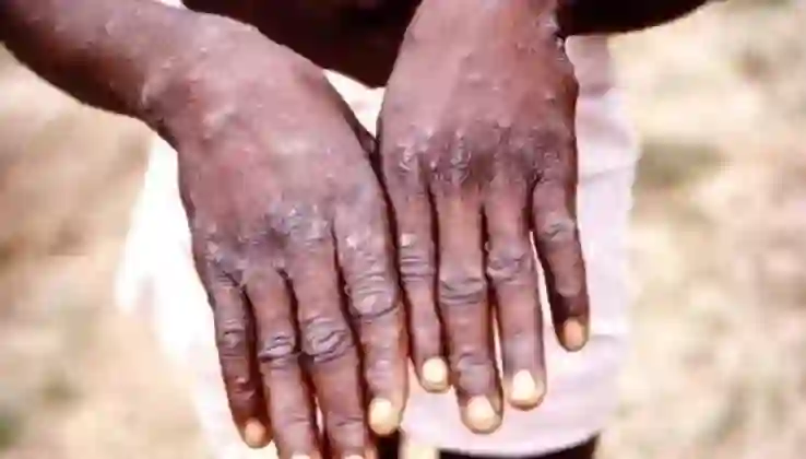 Namibya’da ilk M Çiçeği vakası tespit edildi