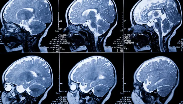 Yenidoğanlarda beyin hasarı erken tespit edilebilecek